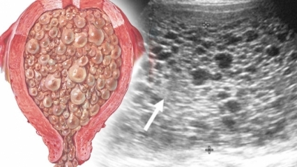 O que é gravidez toupeira (gravidez em uva), quais são os sintomas? Como entender a gravidez toupeira?