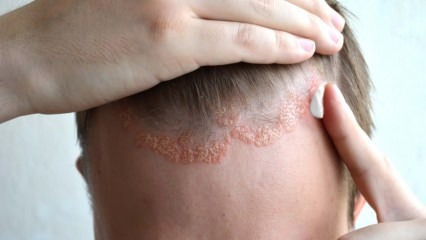 Quais são os sintomas da dermatite seborreica e quem aparece? Alimentos que desencadeiam a doença