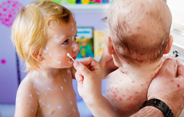 Sintomas de varicela na infância