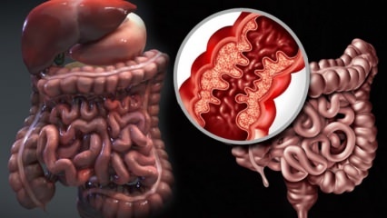 O que é a doença de Crohn? Quais são os sintomas da doença de Crohn? Existe uma cura para Crohn?