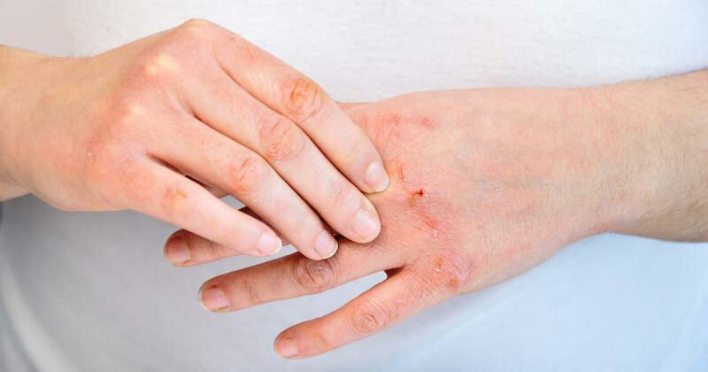 O que é eczema? Como é o eczema o mais fácil? A colônia causa eczema nas mãos?