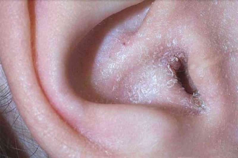 O que causa a descamação atrás da orelha e como isso passa? A solução definitiva para eczema atrás da orelha ...