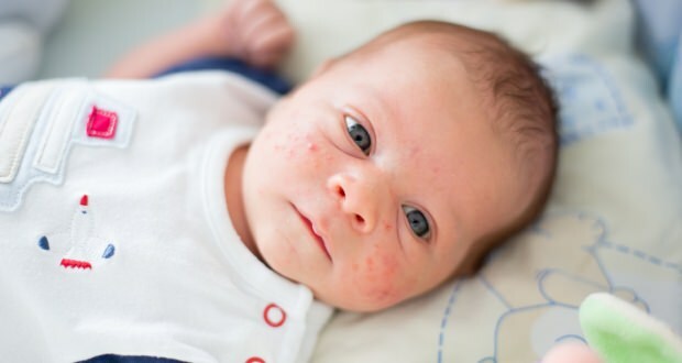 Por que a acne ocorre em bebês?