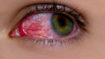 O que causa alergia ocular? Quais são os sintomas da alergia ocular? O que é bom para alergias oculares? 