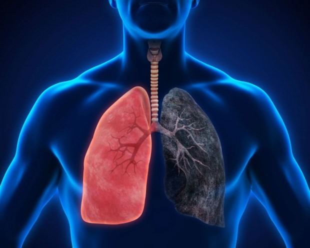 o que é câncer de pulmão