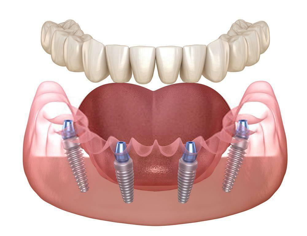 POSSO COLOCAR IMPLANTE IMEDIATAMENTE APÓS A EXTRAÇÃO DO DENTE?