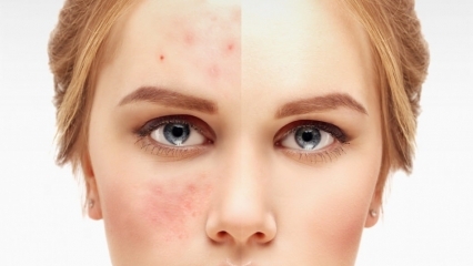 Cremes na farmácia que apresentam a acne mais eficaz em 2020