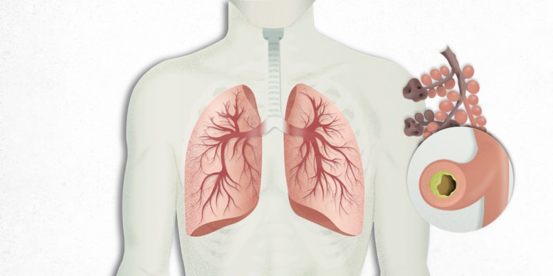 o vírus que se instala nos pulmões é misturado com pneumonia