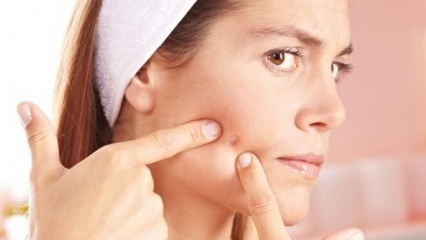 Quais são os acne que não devem ser entediados?