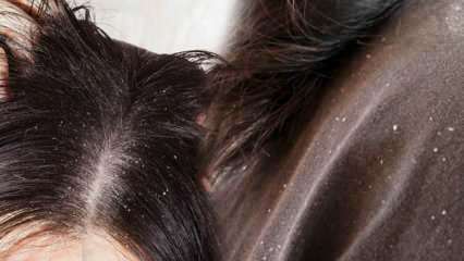 Como a caspa passa e o que é bom para o cabelo com caspa? 5 métodos mais rápidos e eficazes para a remoção da caspa