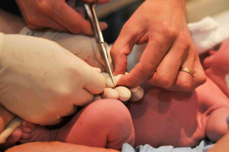 Quando o cordão umbilical deve ser cortado em bebês?