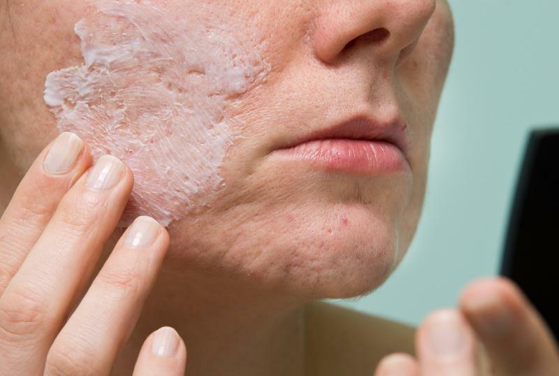 O que causa a acne inflamada e como ela desaparece? Máscara que seca acne inflamada