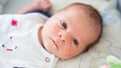 Como a acne passa no rosto do bebê? Métodos de secagem da acne (Milia)