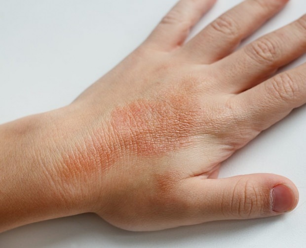 eczema na mão