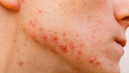 Como a acne cística passa? O que é bom para acne cística?
