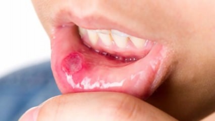 Úlcera na boca!