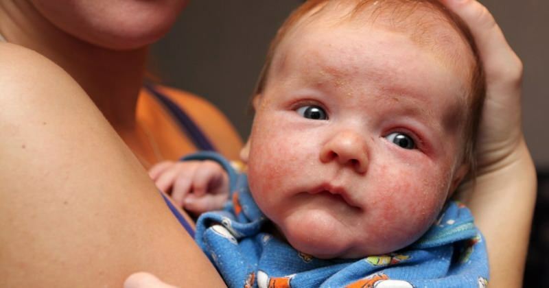 Causas da vermelhidão dos olhos em bebês