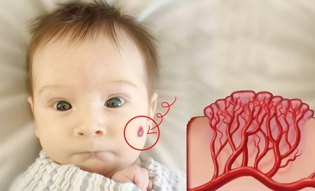 O que é nevo venoso hemangioma? O que causa o hemangioma, qual é o seu tratamento?