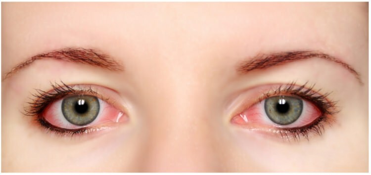 O rímel e o delineador têm alergia nos olhos?