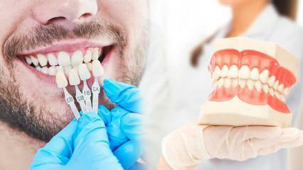 Por que facetas de zircônio são aplicadas nos dentes? Qual a durabilidade do revestimento de zircônio?