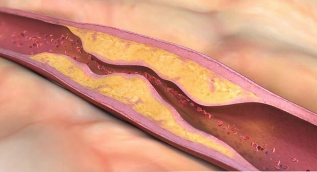 O que causa aterosclerose? Quantos tipos de oclusão vascular existem?