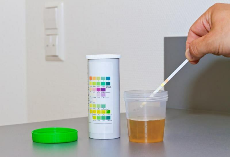 nível de bilirrubina geralmente ocorre no exame de urina