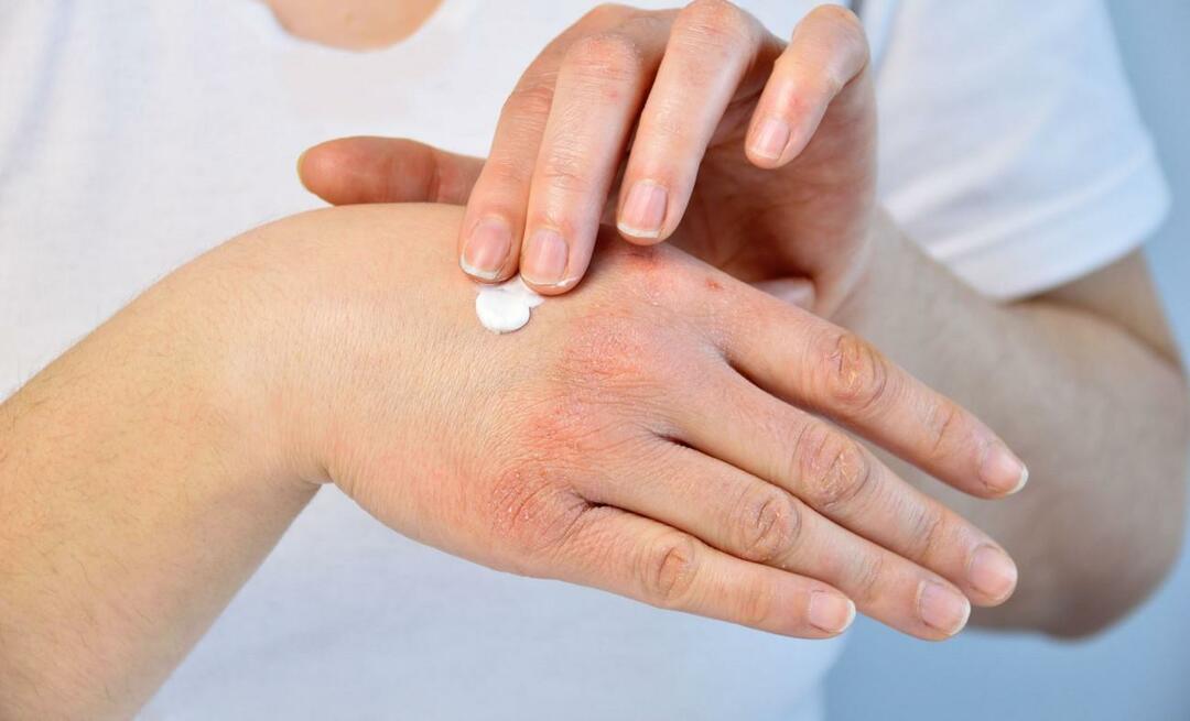O que é eczema de estresse e quais são seus sintomas? Como o eczema relacionado ao estresse é tratado?