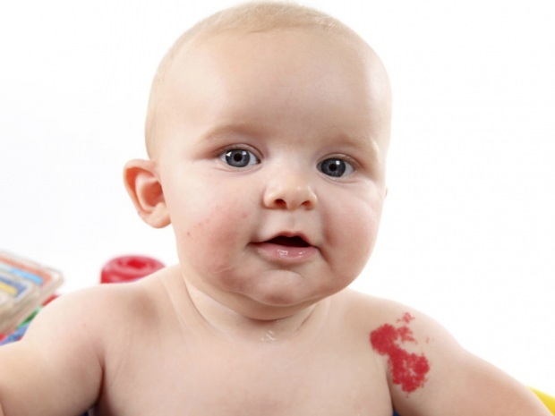 causas da marca de nascença em bebês