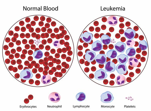 o que é leucemia