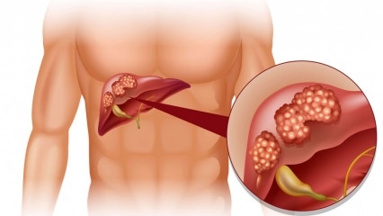 Quais são os sintomas do câncer de fígado? Existe tratamento para câncer de fígado?