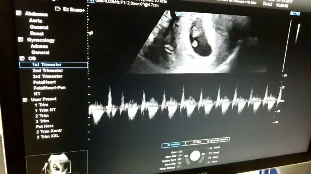 Quando é que o batimento cardíaco do bebê no ventre da mãe é ouvido? Se o batimento cardíaco do bebê não for ouvido ...