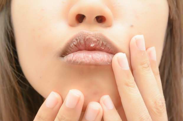 anemia causa lábios secos