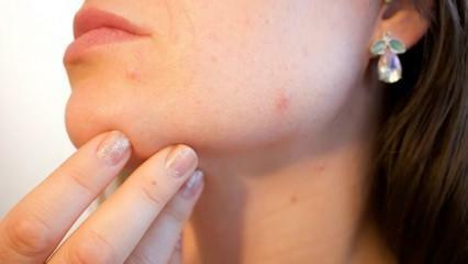O que é câncer de pele (melanoma)? Quais são os sintomas do melanoma e existe cura?