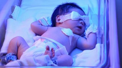 O que é icterícia neonatal? Como a icterícia nos bebês passa em casa? Grau de icterícia em lactentes