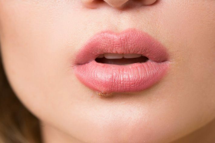 O que é câncer de língua? Quais são os sintomas?