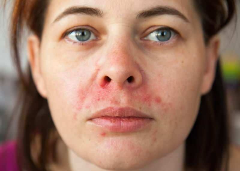 Por que a acne aparece ao redor do lábio? Como é tratada a dermatite perioral?