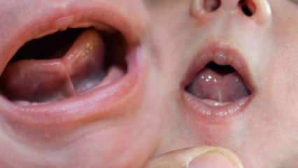 Qual é a ligação da língua (Ankyloglossi) nos bebês? Sintomas e tratamento da língua ...