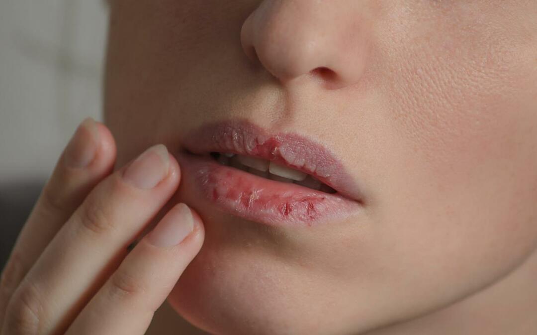 O que causa lábios escuros? Como o escurecimento labial ou hematomas são tratados?