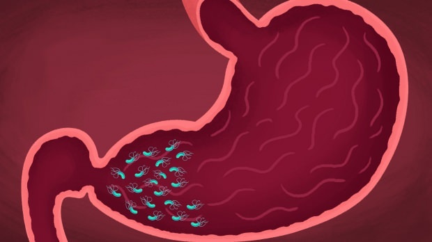 alguns vírus e bactérias podem causar gastrite