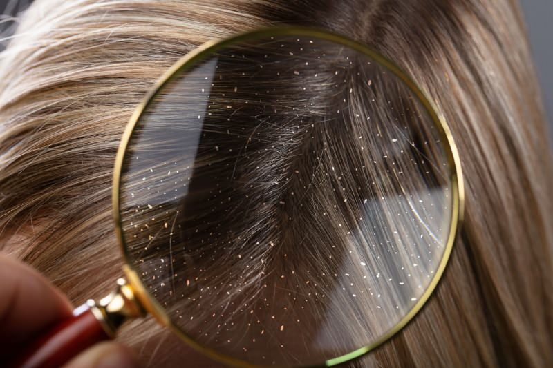 Como a caspa passa e o que é bom para os cabelos? Os 5 remédios caspa mais rápidos e eficazes