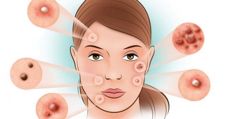 Como a acne é tratada?