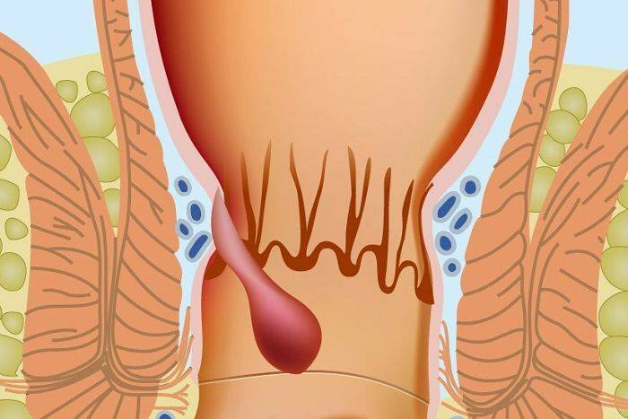 Como as hemorróidas ocorrem na parte anal 