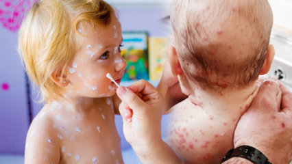 Como entender a varicela na primeira infância e na infância? Sintomas e tratamento da varicela