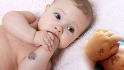 Causa marca de nascença em bebês, é permanente? Quais são os tipos de marcas de nascença? Cura de Saracoglu