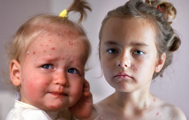 Como entender a varicela na infância e na infância? Sintomas e tratamento da varicela