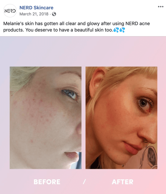 Exemplo de como a Nerd Skincare usou uma foto de antes e depois para criar uma postagem de imagem para mídia social que impulsiona a compra de seus produtos.