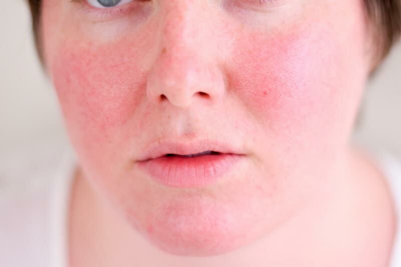 Como o rosto avermelhado passa? Os melhores produtos de cuidado contra a vermelhidão facial