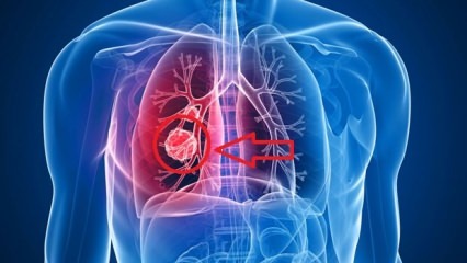 Sintomas do câncer de pulmão: estágios do câncer de pulmão!