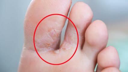 O que é fungo do pé? Quais são os sintomas do pé de atleta? Tratamento do pé de atleta 