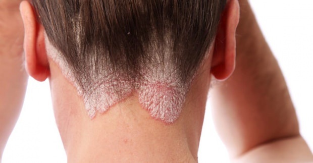 Sintomas e tratamento da dermatite seborreica